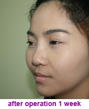 plastic_surgery_augmentation_rhinoplasty